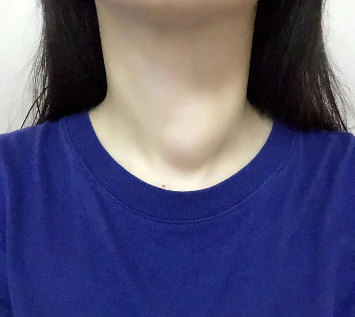 这么好看的脖子,你肯定没想到我有过甲状腺结节吧.因为已经好了.