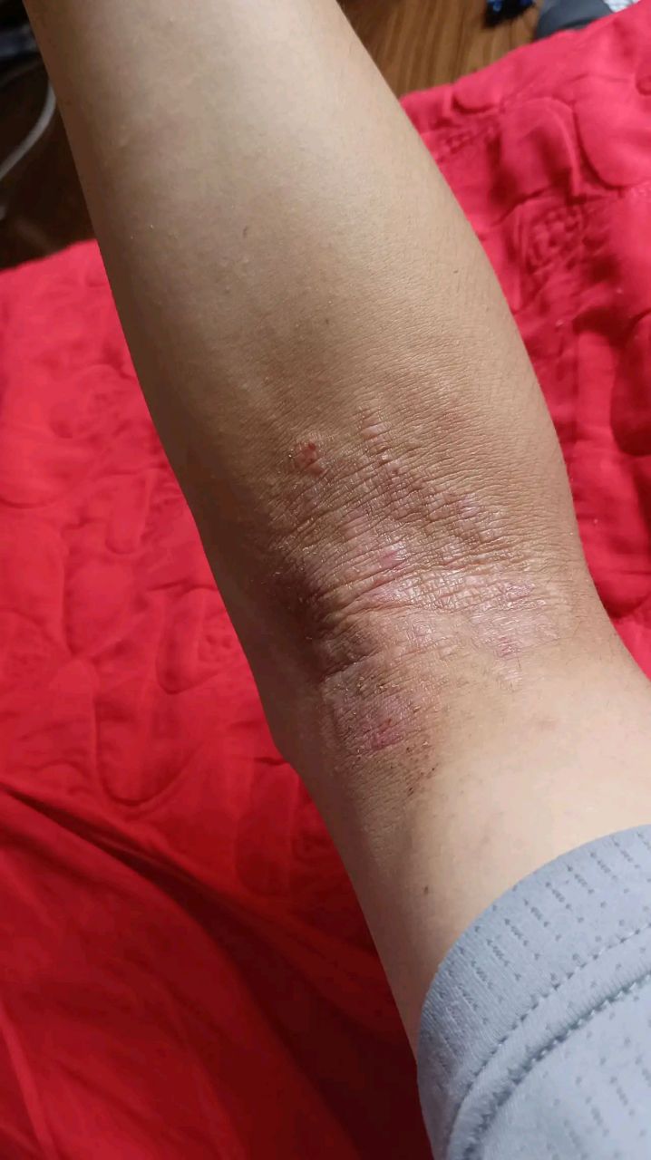 也开始痒.这是血里面热毒icon吗. 不知道用什么药能 弄好