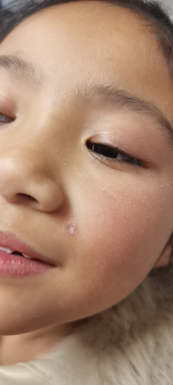 请大家帮我想想办法,我女儿点痣留下的红印子怎么才能去掉?