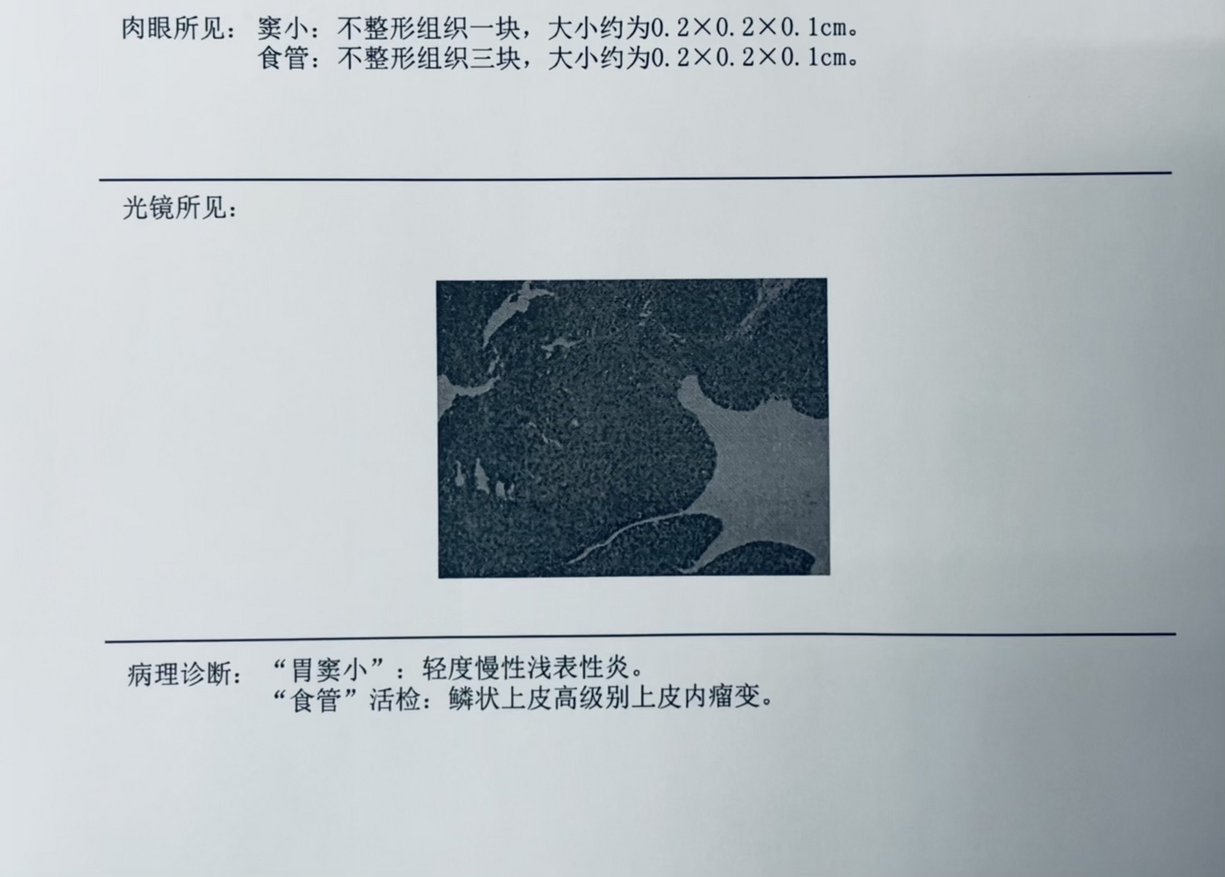 食道癌活检报告图片图片