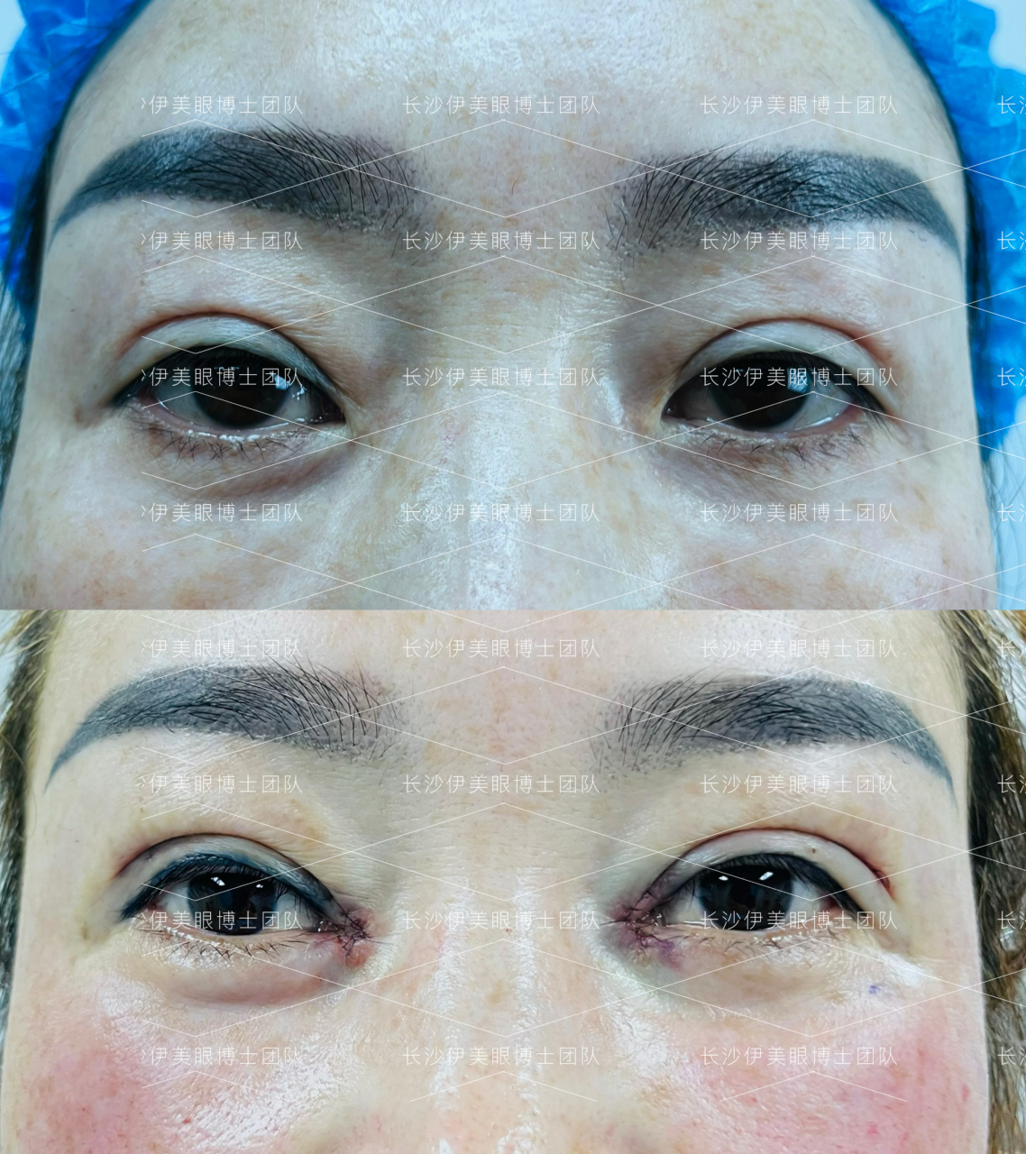 贵州夏女士内眼角修复(开) 眼尾提升.