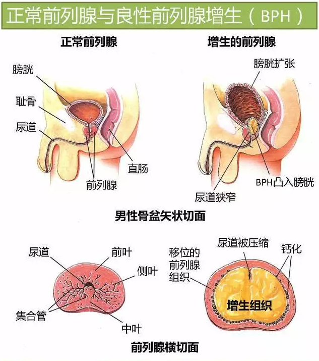 良性前列腺增生藥物治療(一)