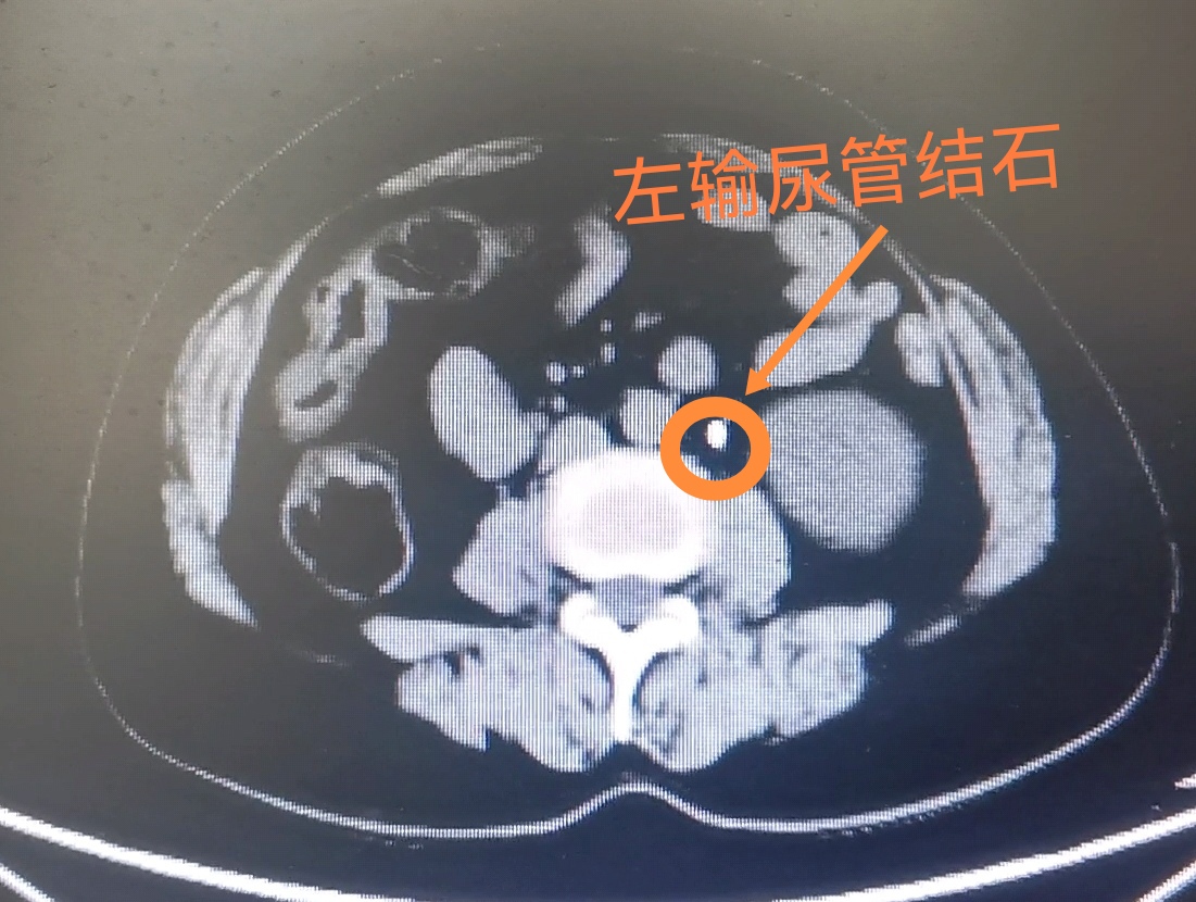 肾结石超声波碎石图片