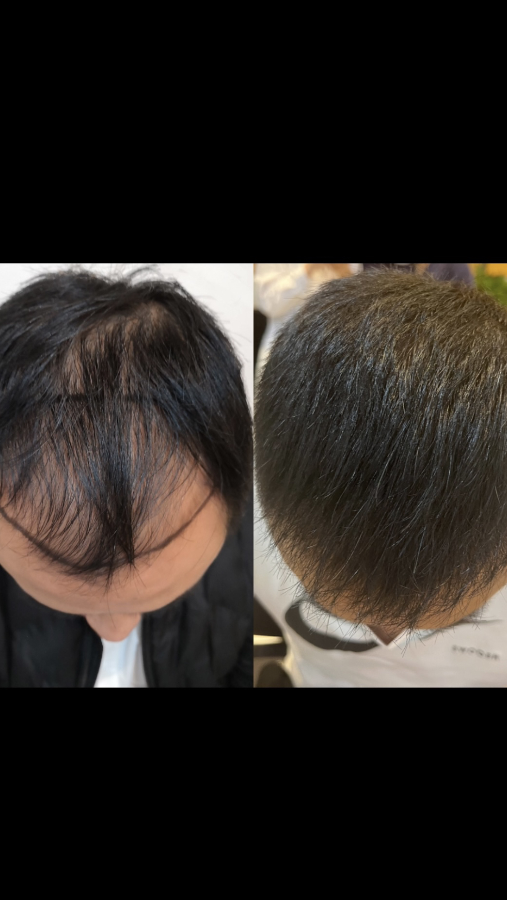 植发半年真实效果