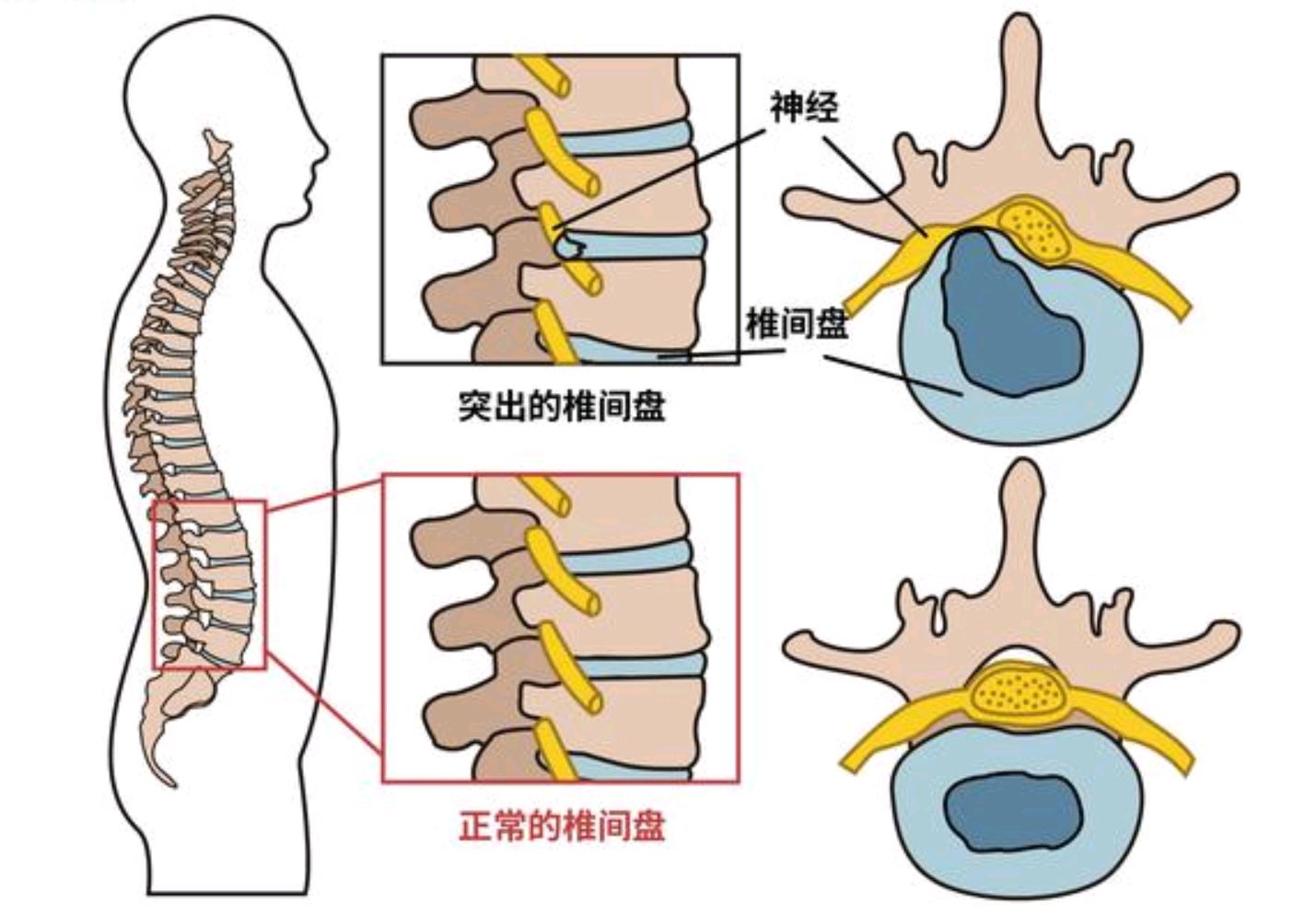 腰椎间盘突出症患者为什么出现腰不疼而腿疼