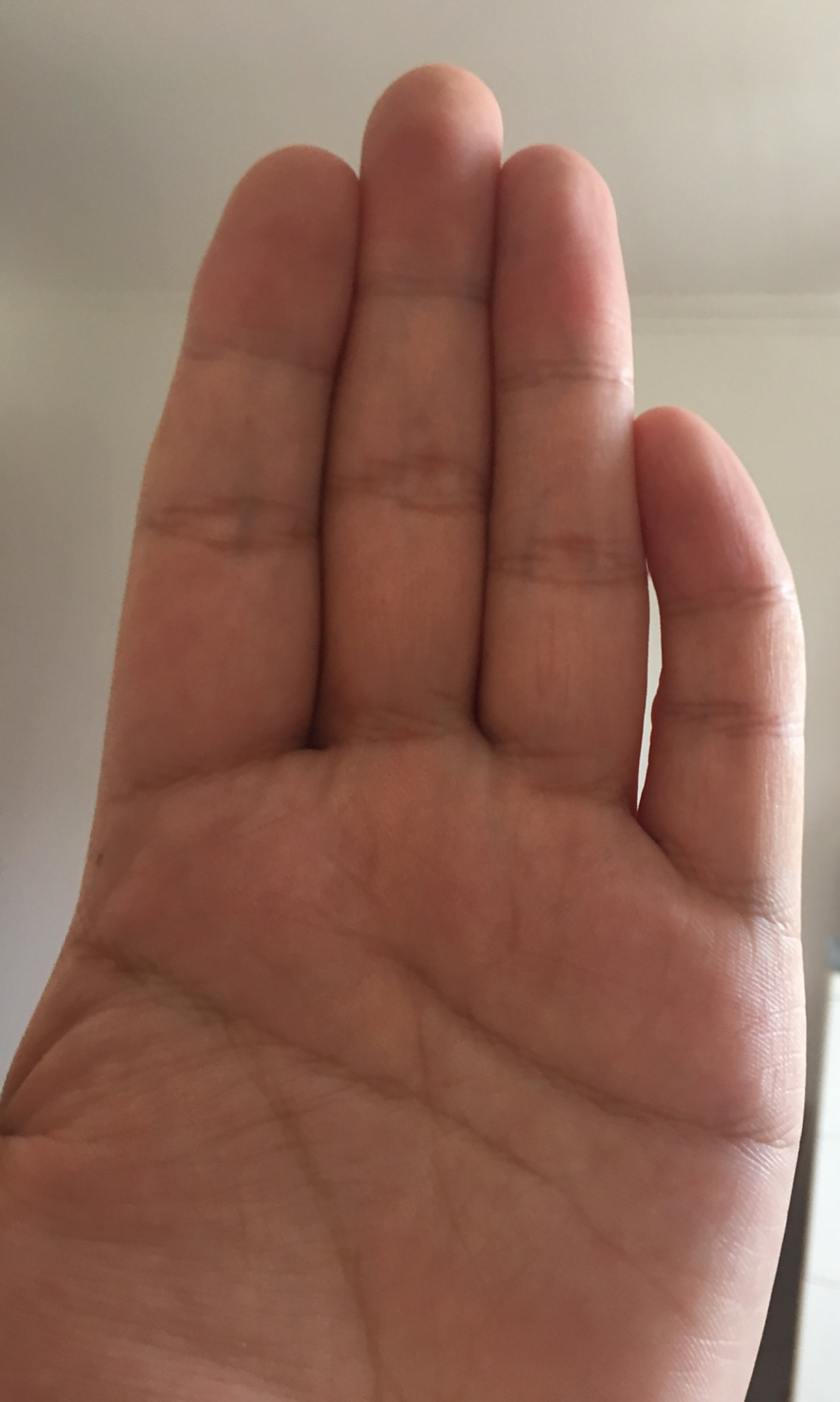 我的小拇指长歪了不知道还能不能治好