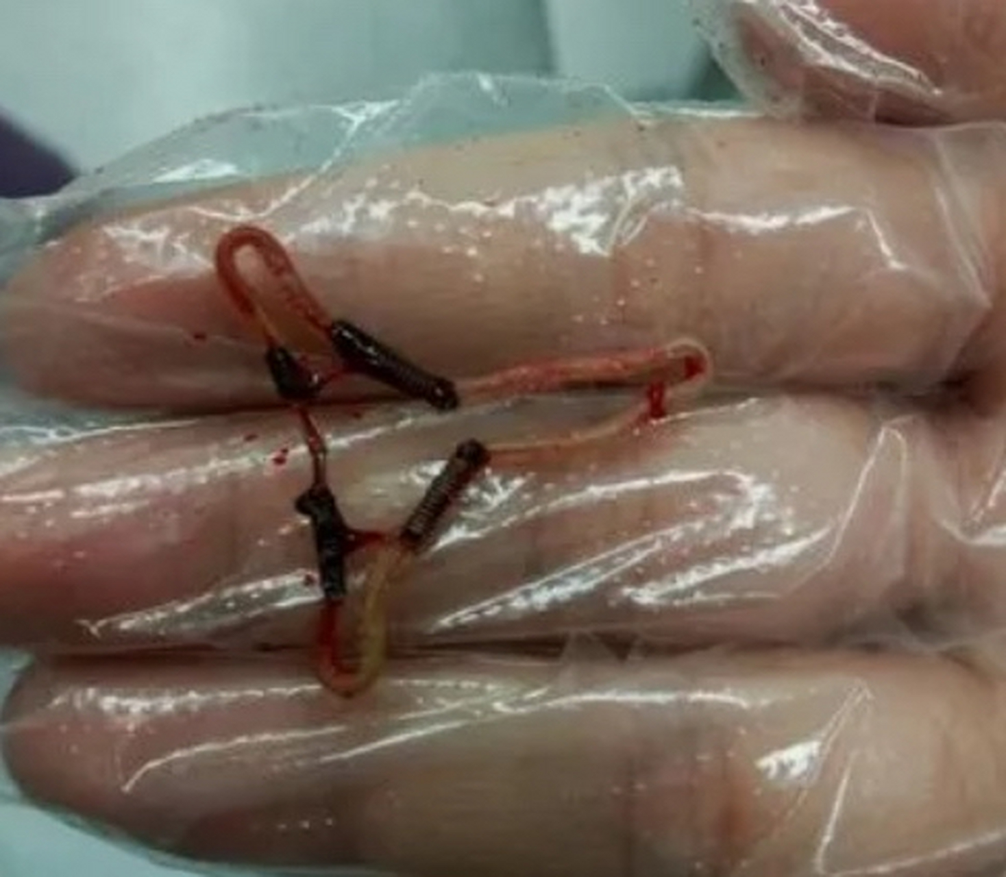 女儿带我去取节育环!