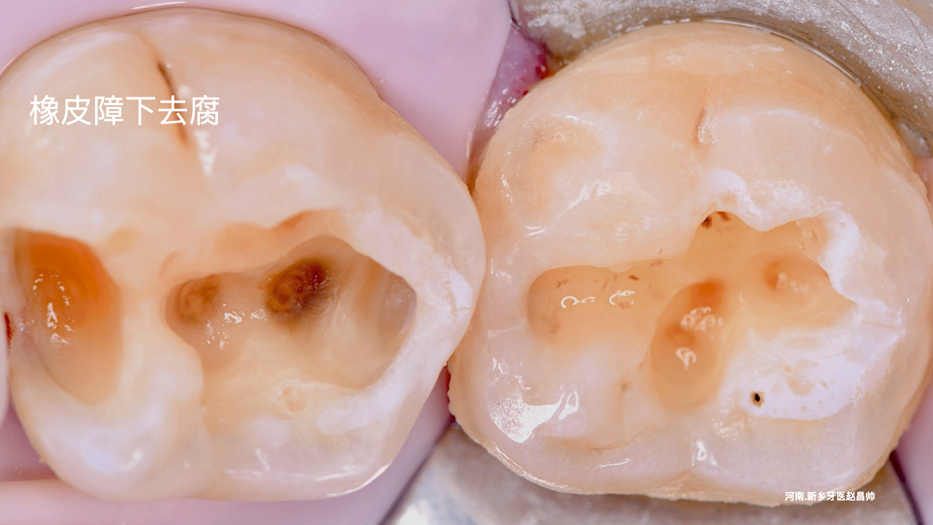 牙釉质龋切片图片