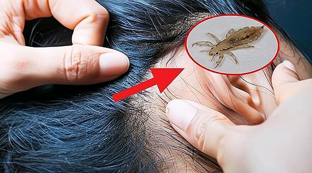 七八十年的虱子都是哪来的?一文带你回到曾经的童年"虱"代