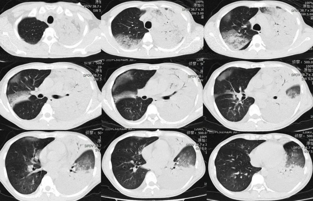 迎战偏肺病毒,练好八锦缎是关键