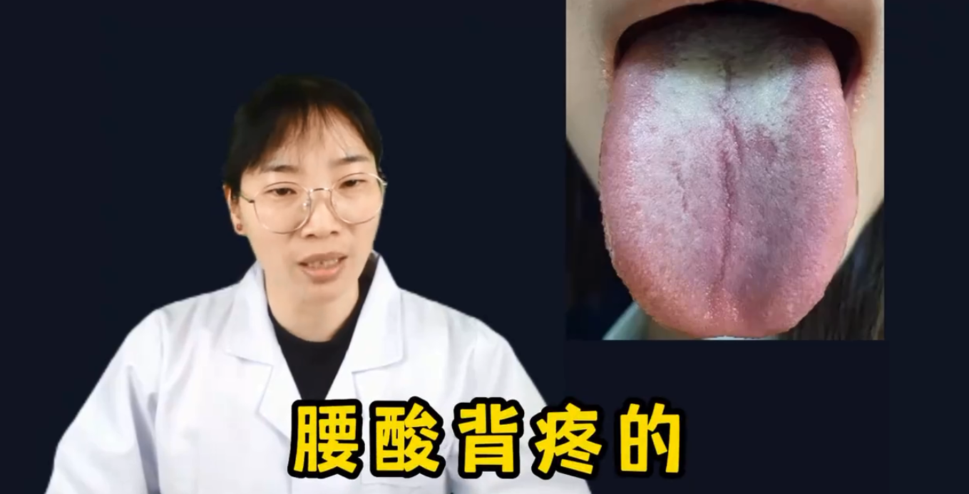 舌诊实战:脾胃阴虚,下焦湿热!舌根苔厚,舌头中间有裂纹