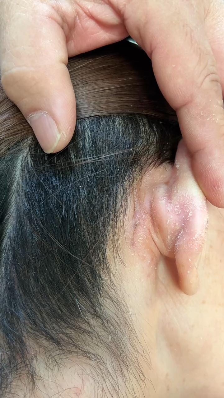 人工耳蜗术后复查,伤口小,愈合良好-度小视