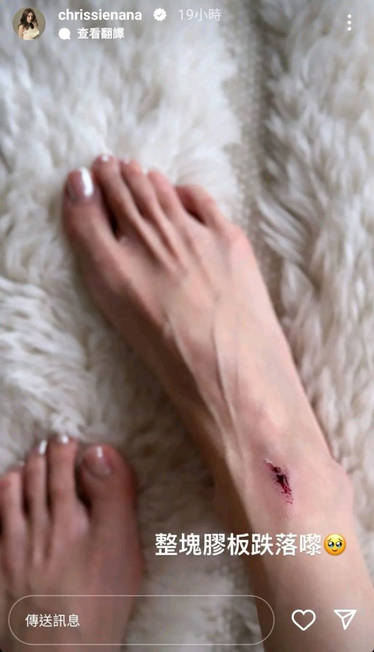 名模周秀娜晒受伤照,伤口又红又深令人心疼,脚掌瘦到皮包骨  名模