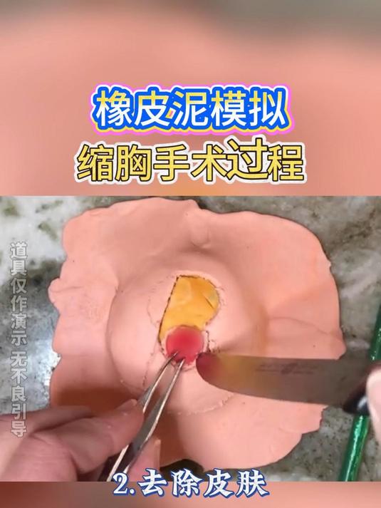 橡皮泥模拟缩胸手术过程