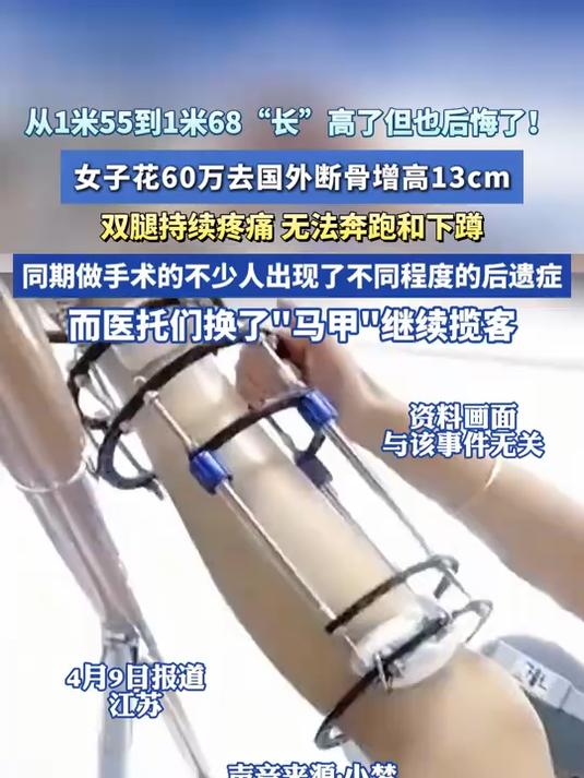 女子花60万去国外断骨增高13cm,双腿持续疼痛,无法奔跑和下蹲