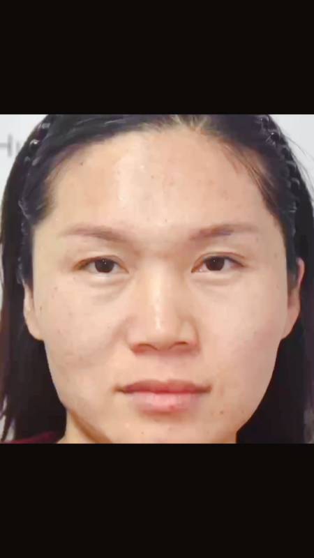 眉毛下垂通常可以选择找美颜医生做眉毛复位-度小视