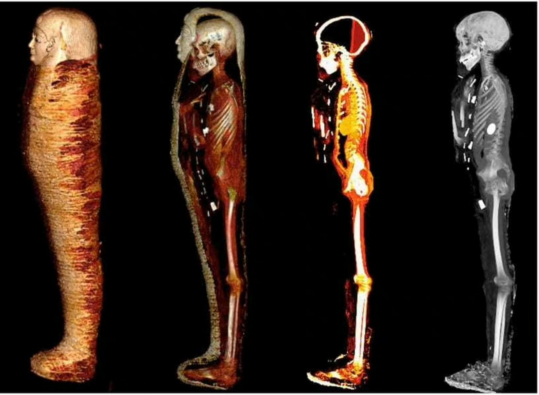 讀到1月24日《journal frontiers in medicine》上的一篇: 埃及開羅