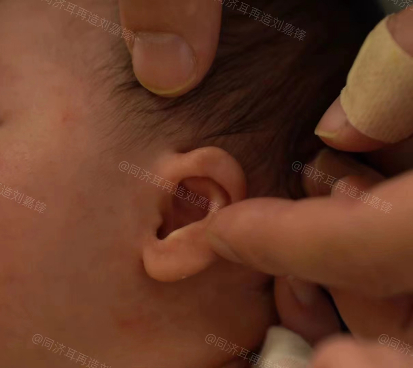 孩子刚满月,两只耳朵一大一小,对比很明显.
