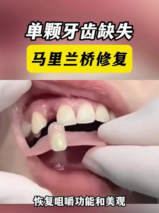 单颗牙齿缺失又不想种牙,马里兰桥了解一下