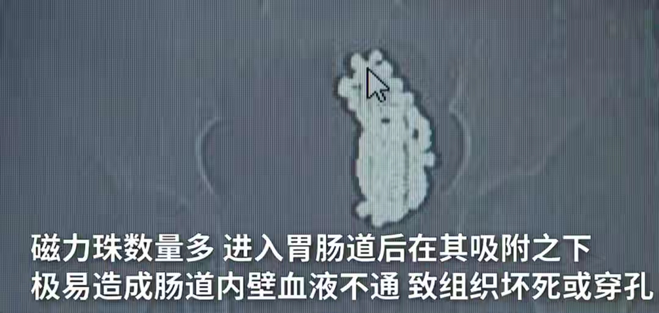 误吞磁力珠多久会有反应=误吞磁力珠对哪里影响最大