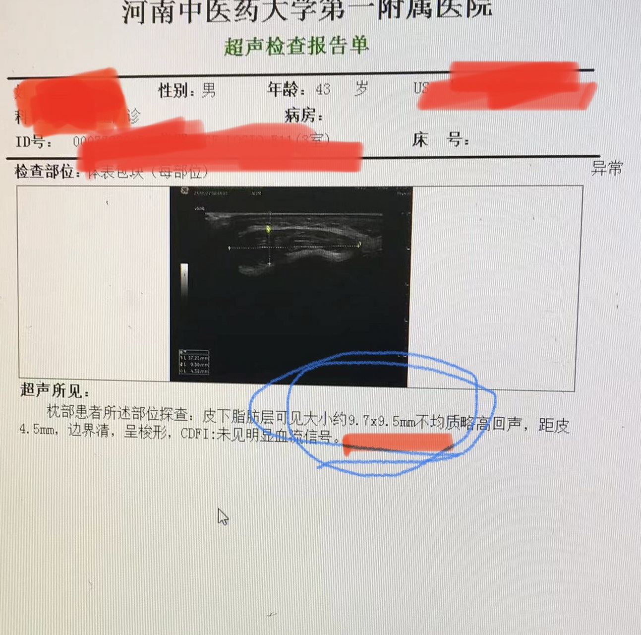 头部单发的包块(脂肪瘤)  原来大小:40*8.3mm,  现在大小:9.7*9.