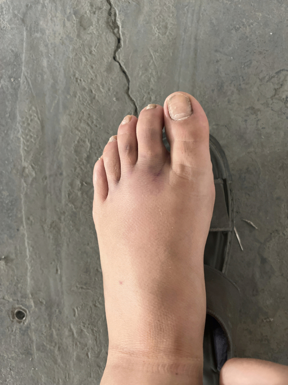 脚被原料砸肿了,以为能得到点安慰,谁知道人家只说了句,正常