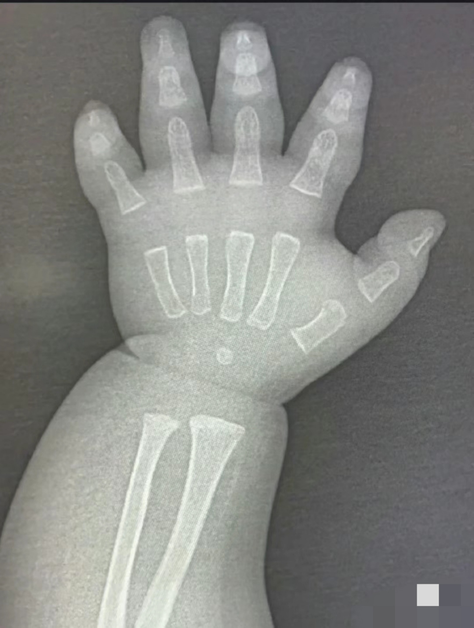 x光下小朋友的手手也太可爱了[大笑]