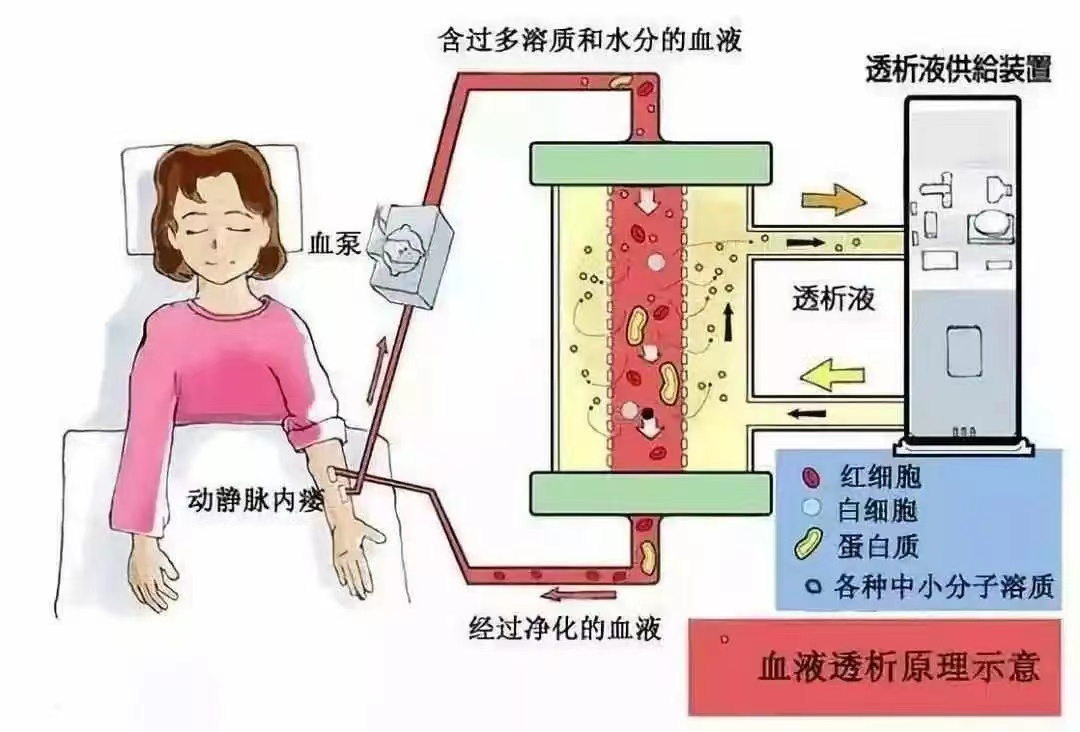 什么是血液透析