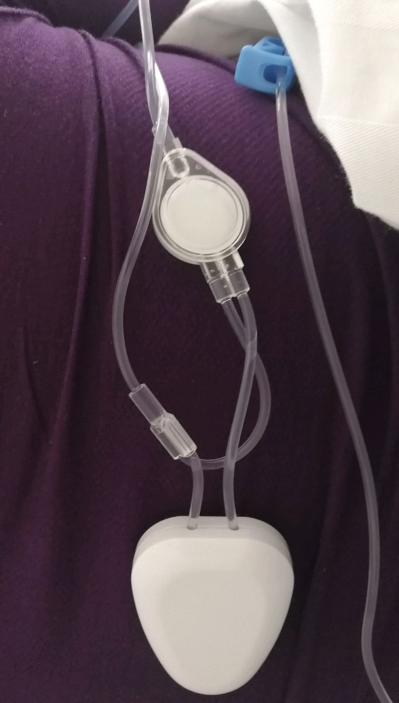 国庆节期间使用止疼泵想到的