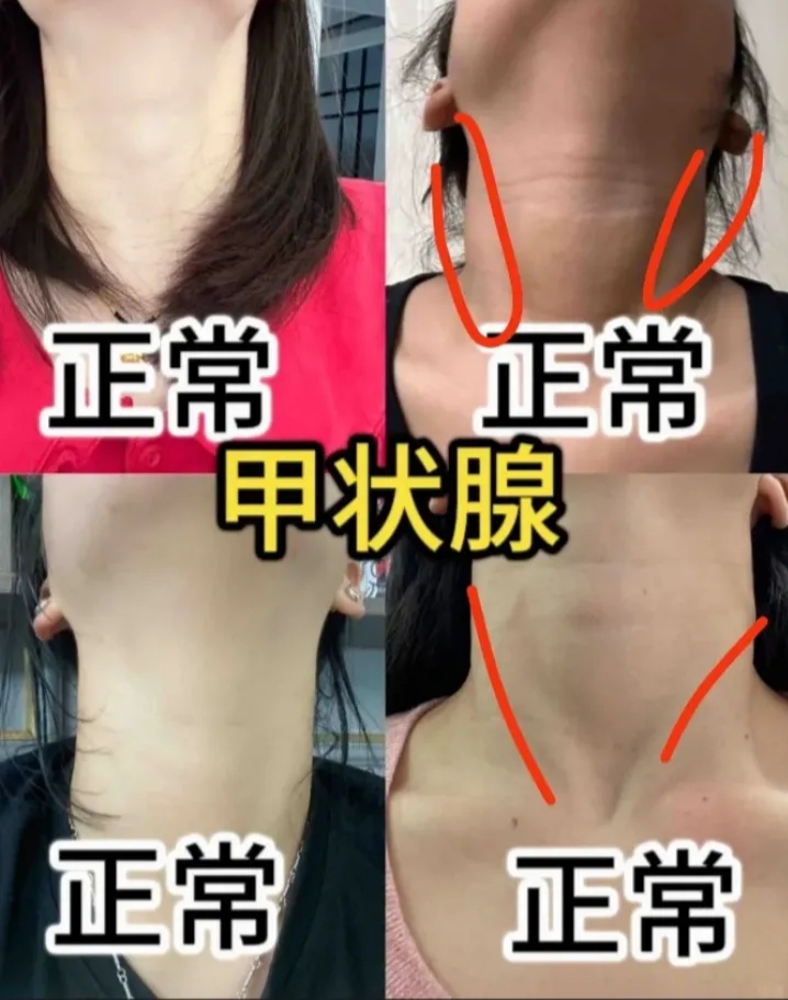 检查甲状腺是否正常可以通过以下几种方式: