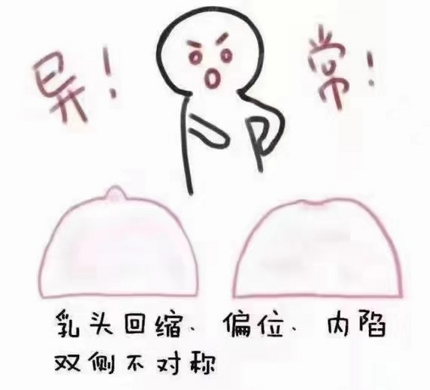 乳 头内陷严不严重[疑问] 先天性的乳 头内陷一般是发育不良慢性炎症