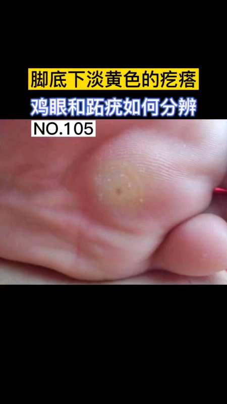 脚底下淡黄色的疙瘩-鸡眼和跖疣如何分辨-度小视