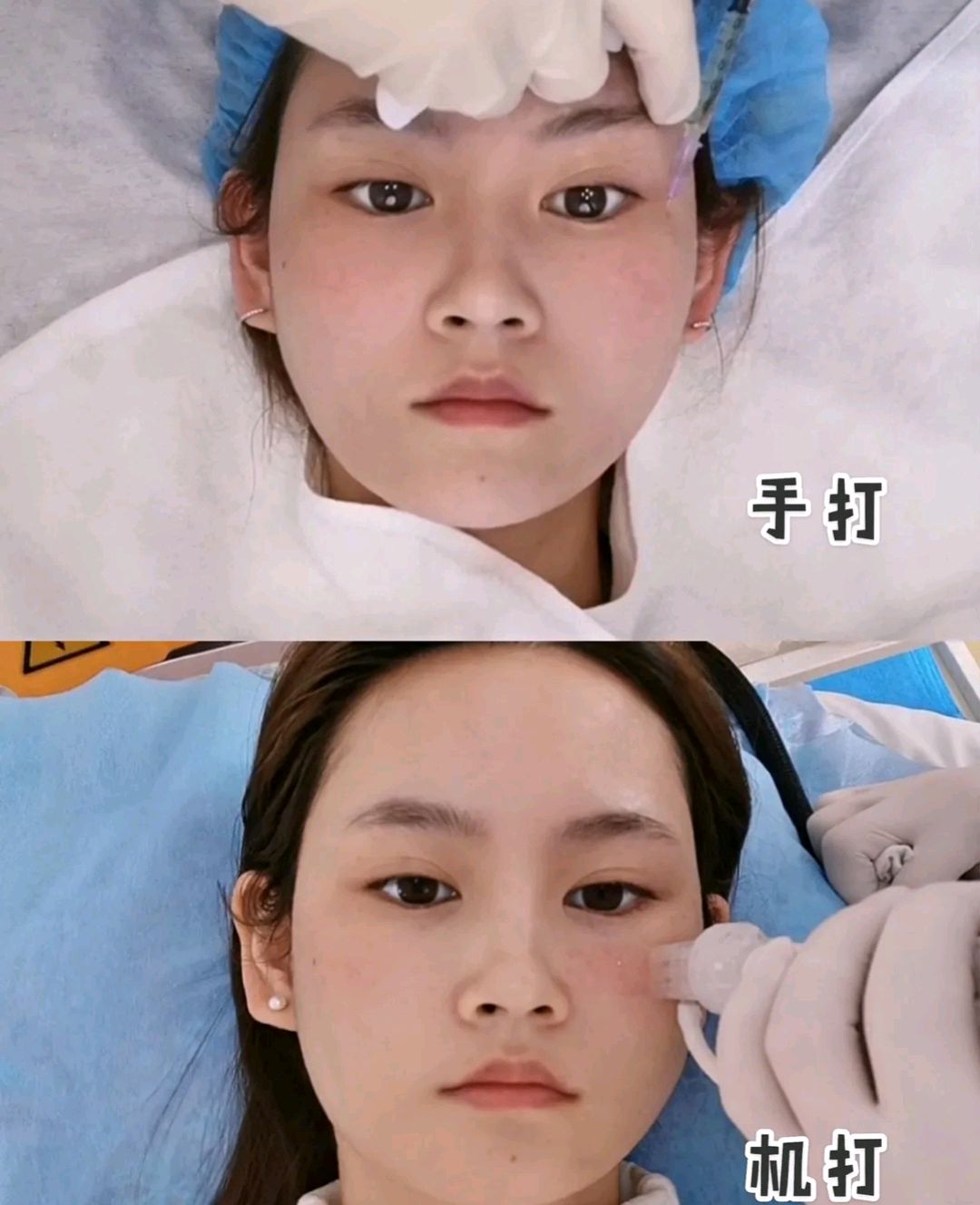 水光针机打还是手打效果更好呢?