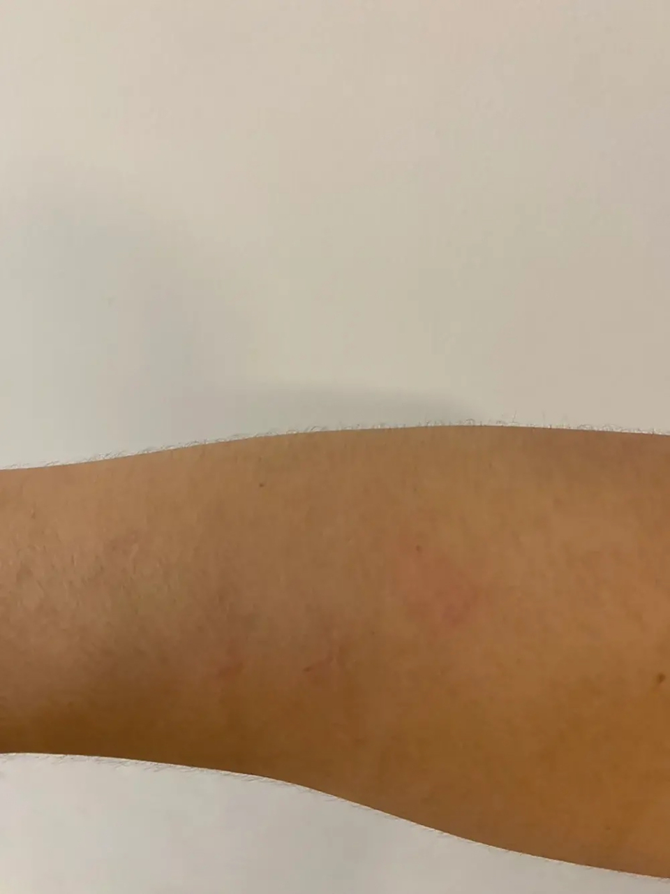 失业第二天,被媳妇抓破了胳膊!