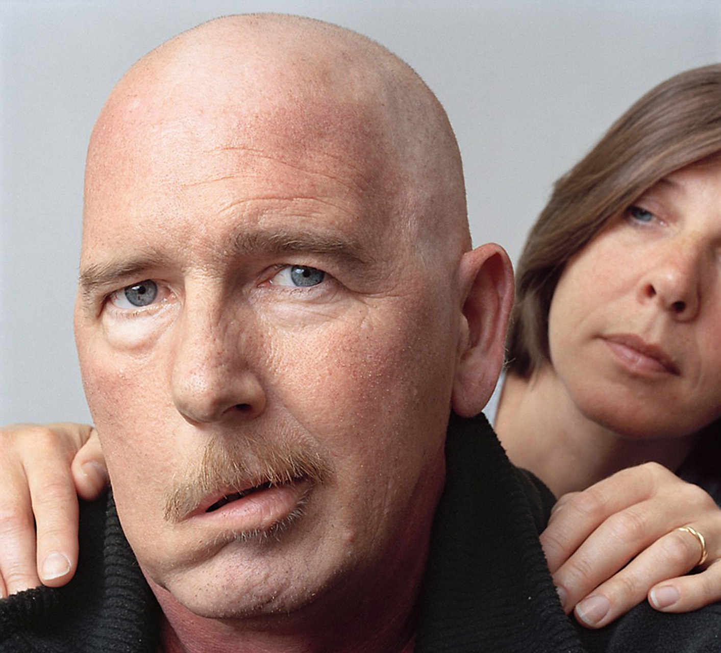 面瘫是典型的经筋病   面瘫俗称口眼歪斜 ,西医认为是面神经麻痹了 .