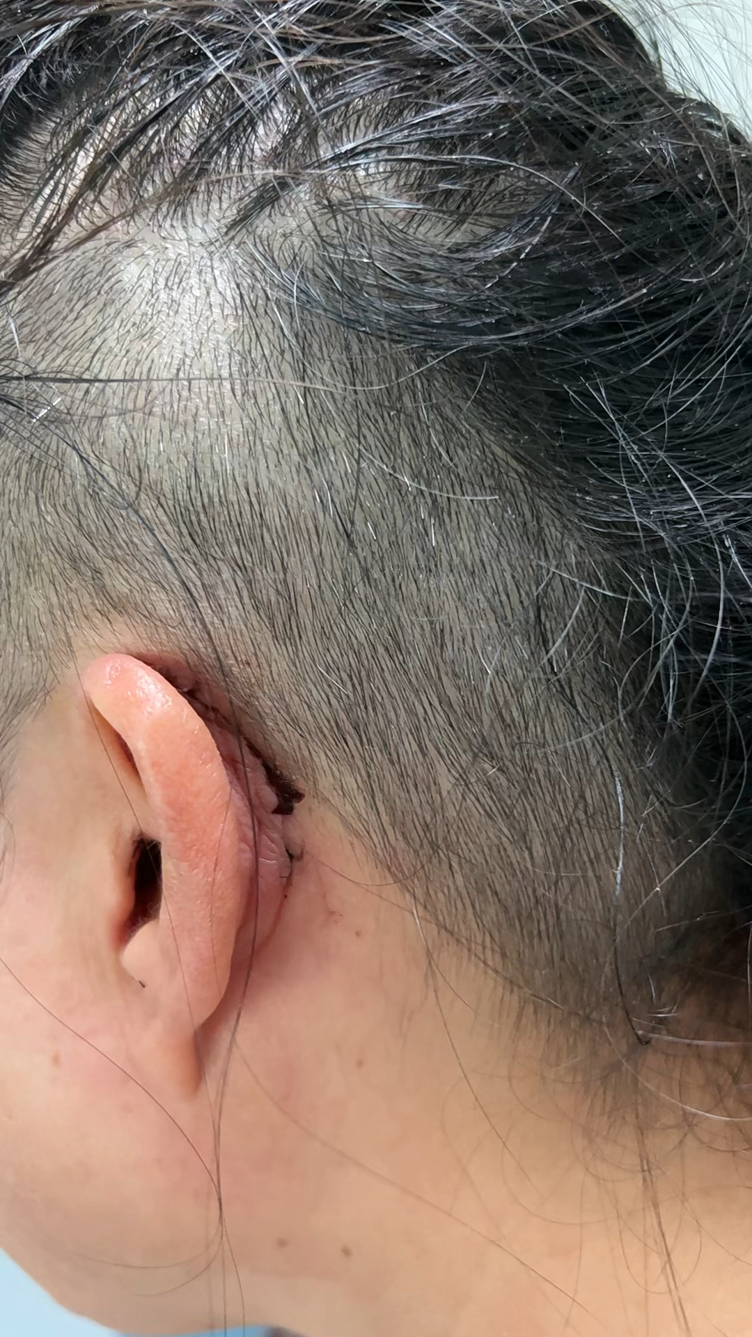 成人人工耳蜗植入术后2周复查
