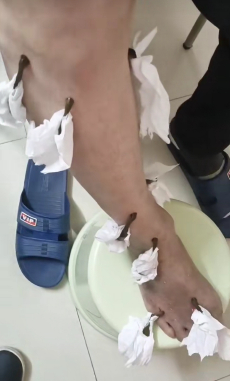 蚂蟥吸血,能治疗什么病?