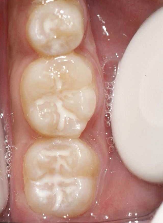 窝沟封闭是一种口腔预防性措施,可有效预防龋齿,保护牙齿健康.