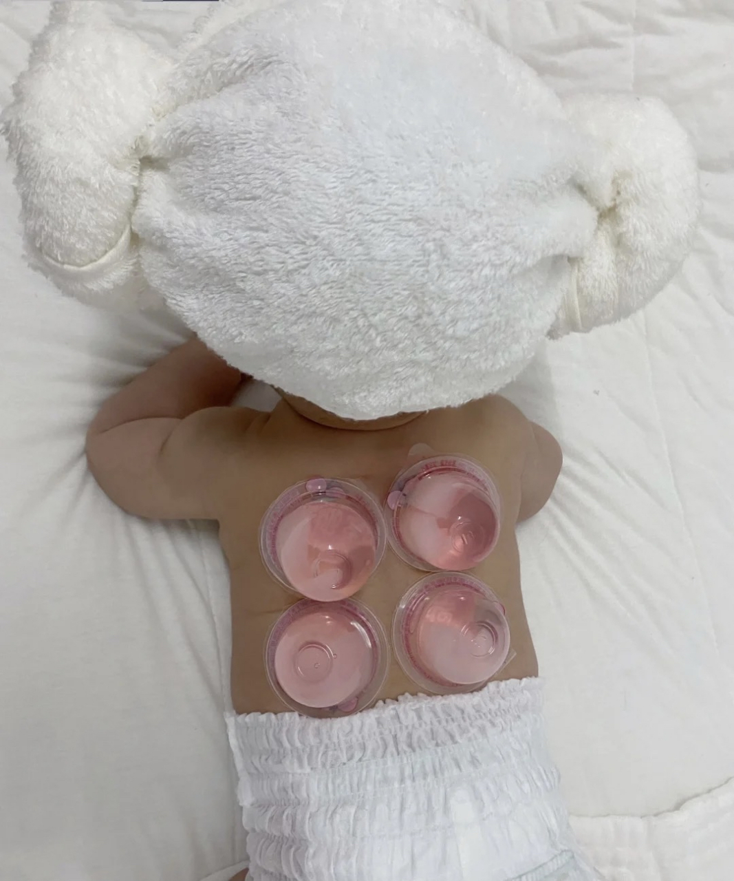 记录孩子第一次拔罐 给老婆说小孩不能拔罐,她非要,说孩子需要,然后又