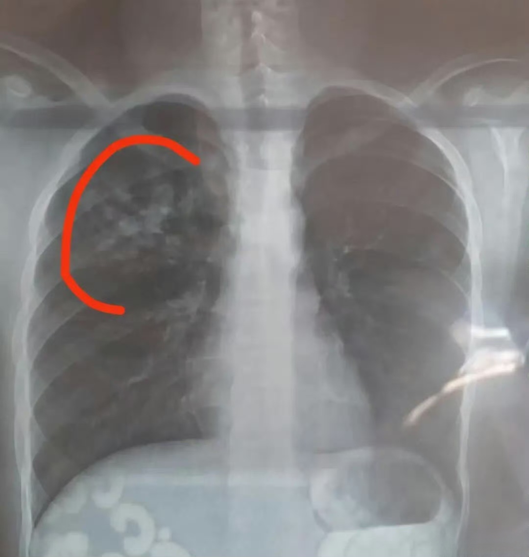 最近,支原体肺炎,大叶性肺炎,肺实变的患儿增多,住院