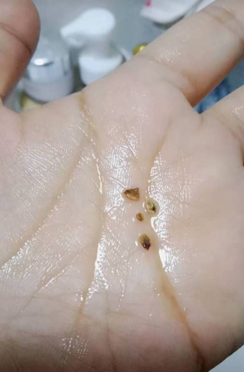 今天早上刷完牙感觉有个硬硬的东西,竟然把牙结石刷出来了,之前去补牙