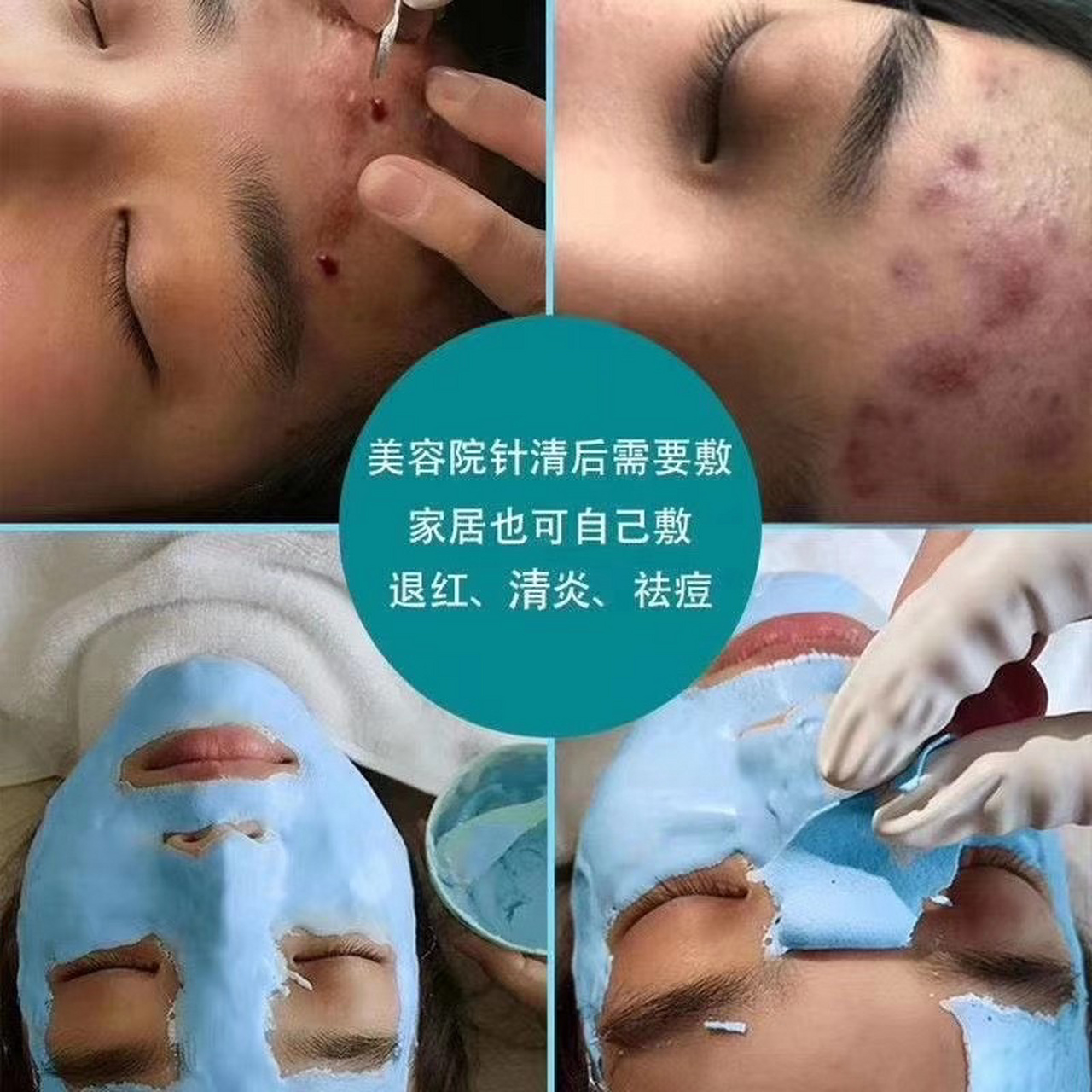 妙萃冰膜粉 祛痘消炎 祛痘印痘坑修复面膜消炎补水保湿面膜粉软膜粉