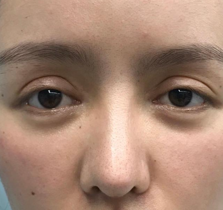 什么原因会引起眼窝凹陷,该如何填充?怎么减少眼窝凹陷的发生?