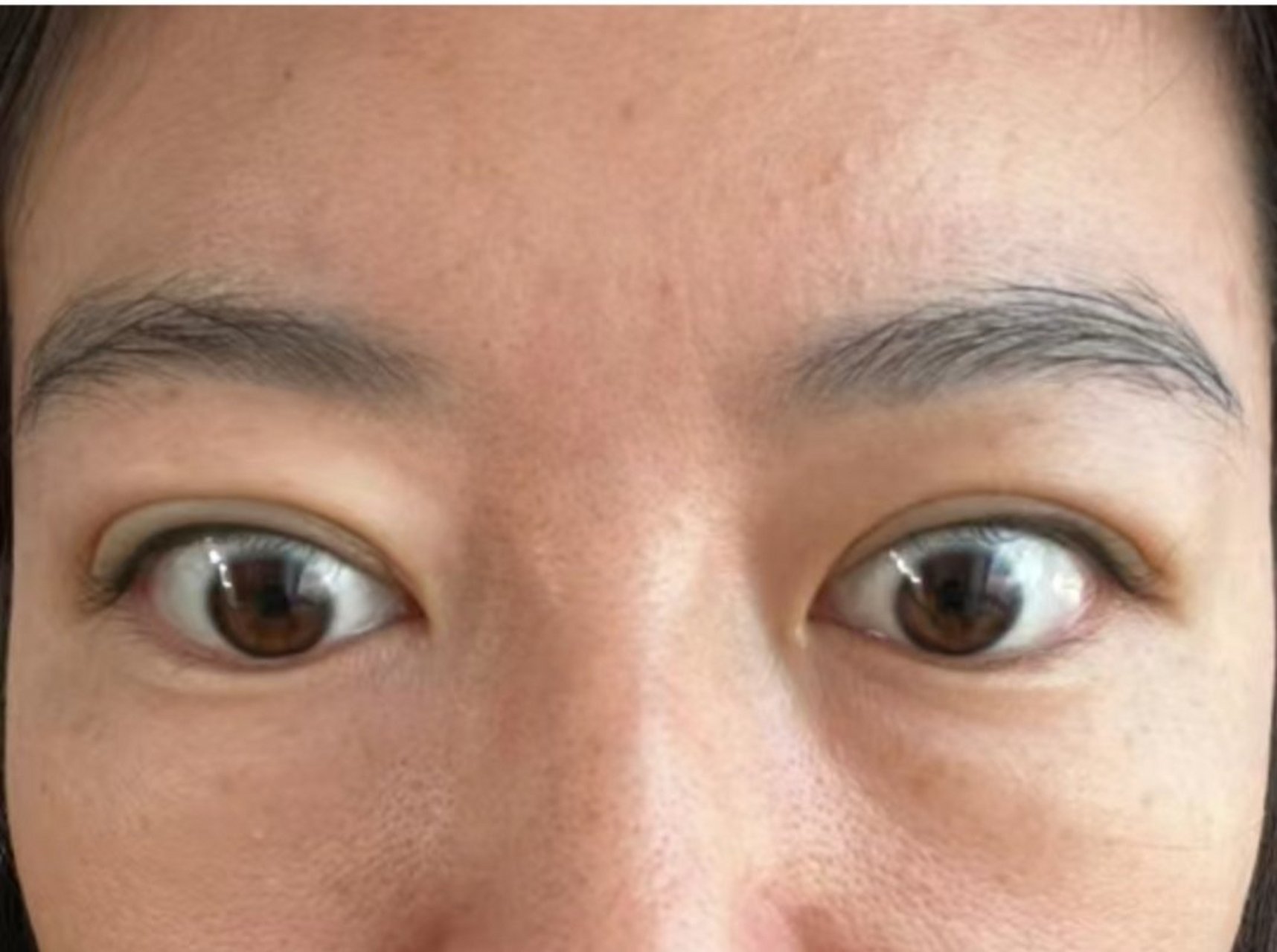 甲亢好了!感觉眼睛都舒服多了!