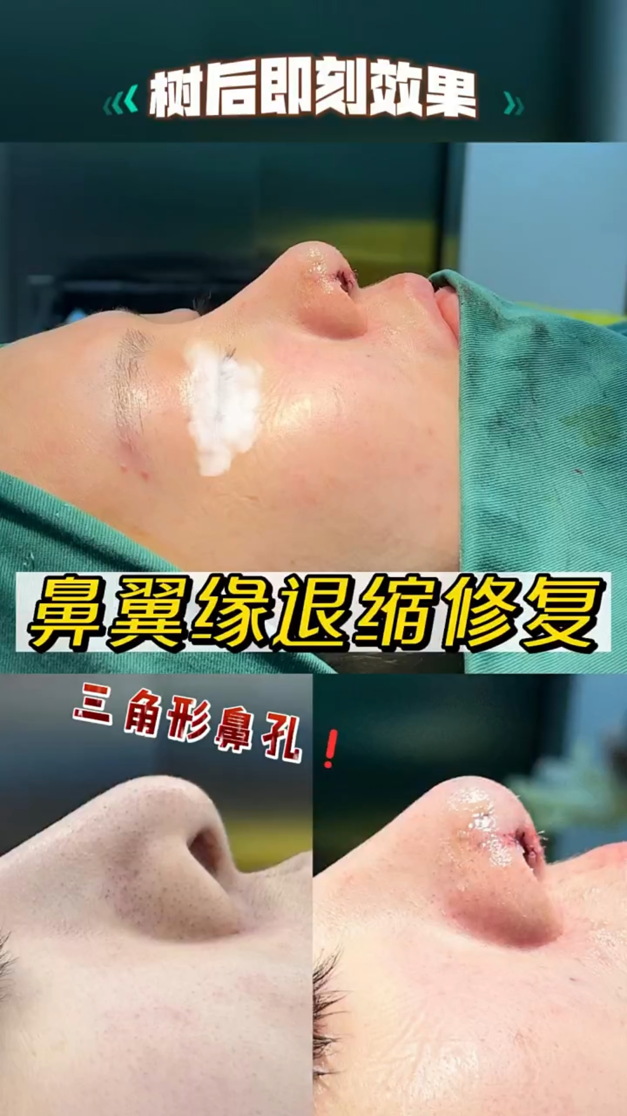 鼻翼缘退缩修复,三角形鼻孔修复成功