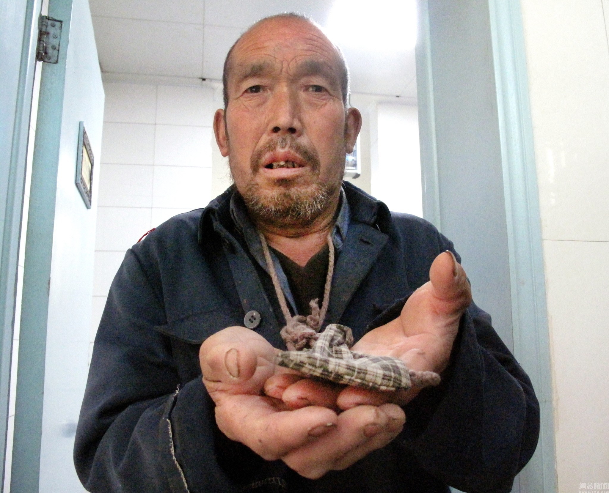 治好6年高血压的拾荒老人之后,我不由得感慨:久病床前无孝子!