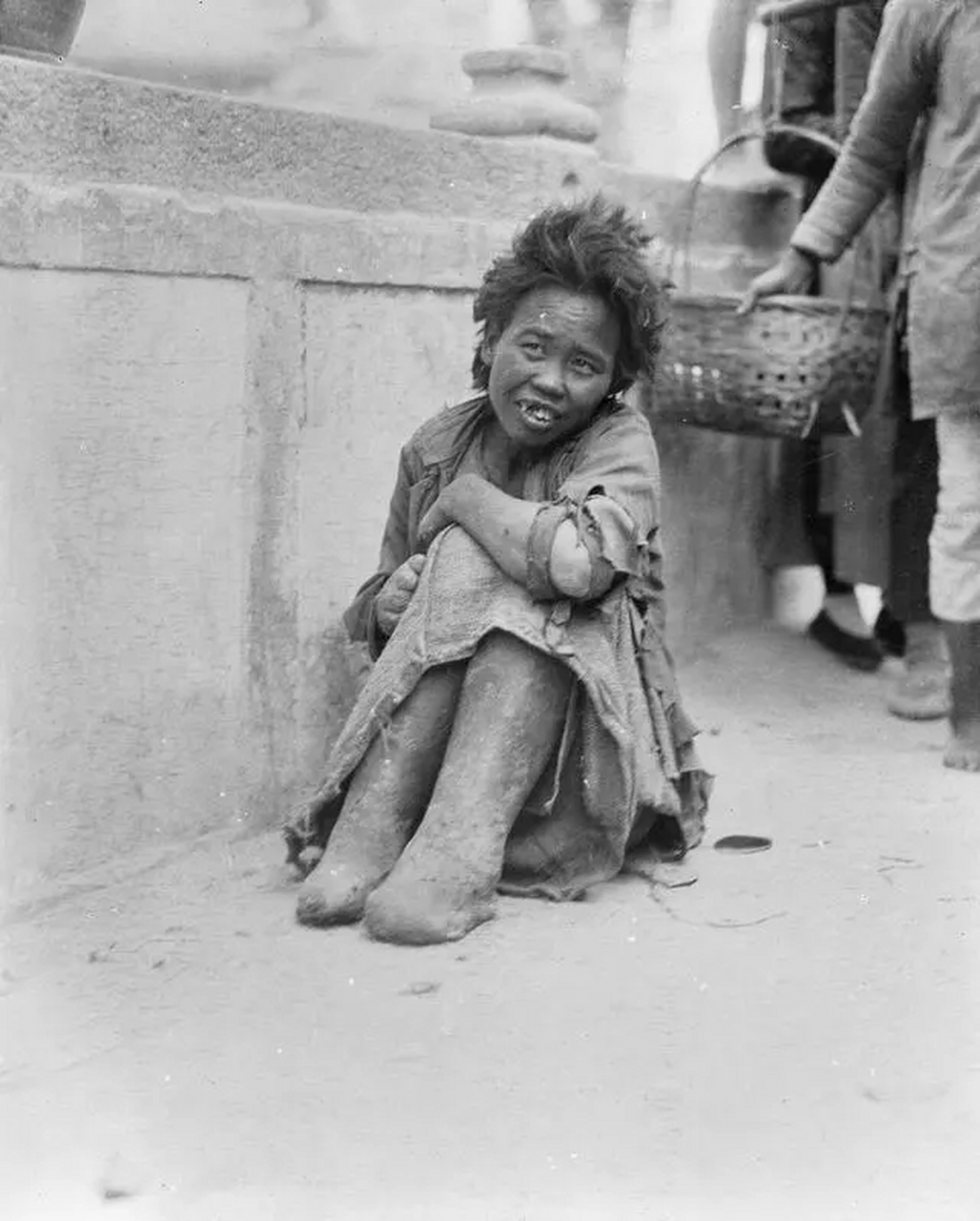 1917年的广东汕头,一位女麻风病人坐在桥上,手脚都穿上了厚厚的衣套