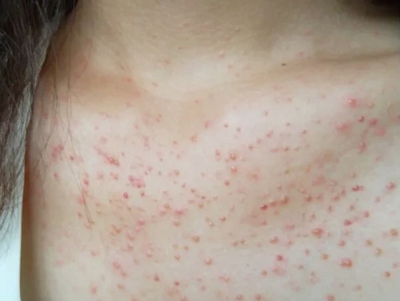 这是两种不同的毛囊炎,处理不一样  第一种——细菌性毛囊炎 01