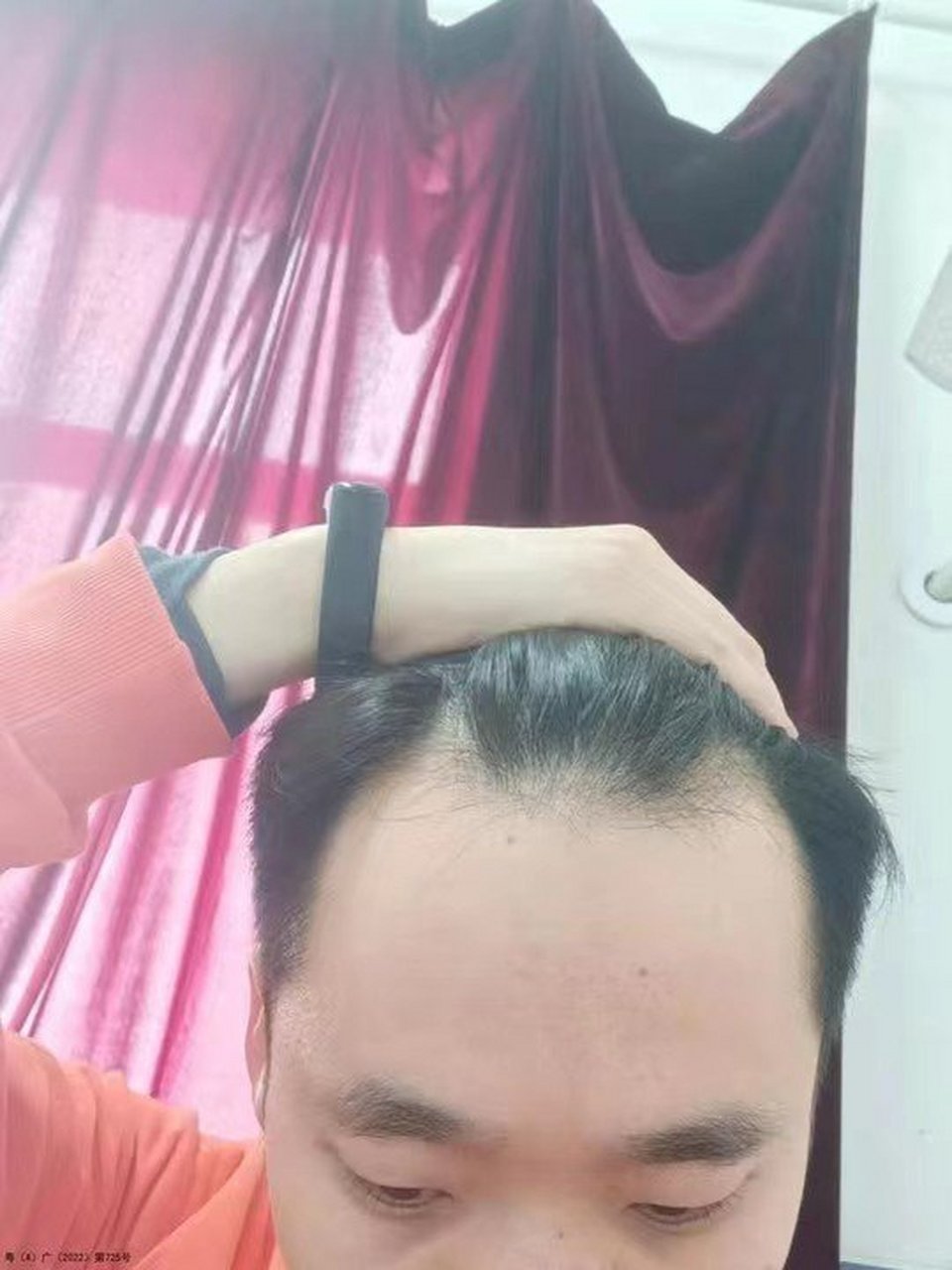 我是发际线上移,头发容易油.想问一下徐医生,我这个情况应该怎么办?