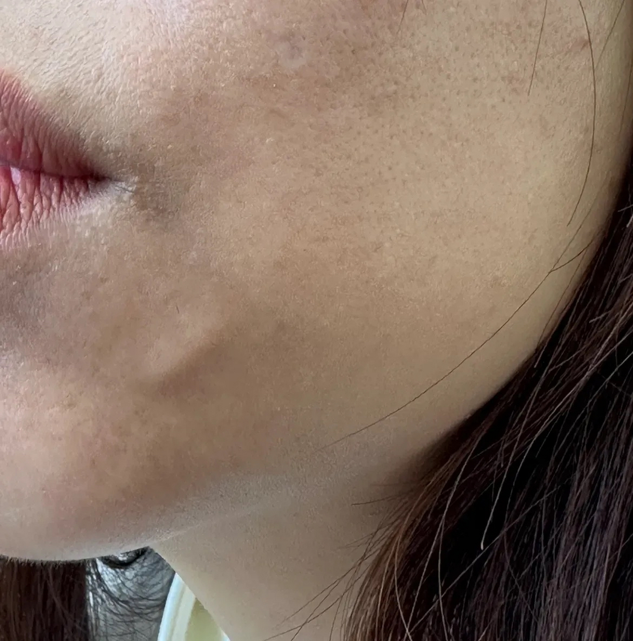 她之前做过线雕,嘴角鼓起"小胶囊",有一根线没吸收,形成了鼓包.